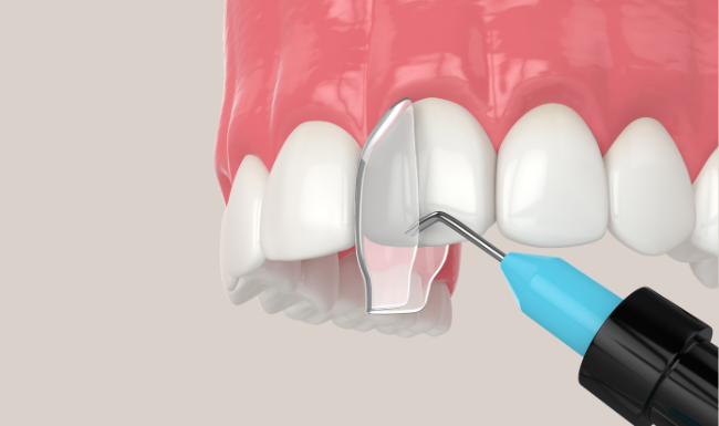 Composite Bonding